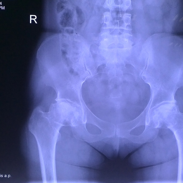 右側全髖關節置換